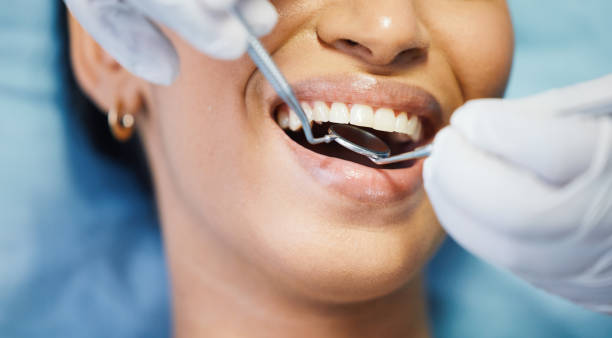Best Emergency Dentist for Lost Fillings or Crowns in Woods Cross, UT